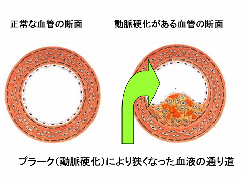 心筋梗塞