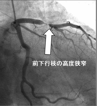 前下行枝の高度狭窄